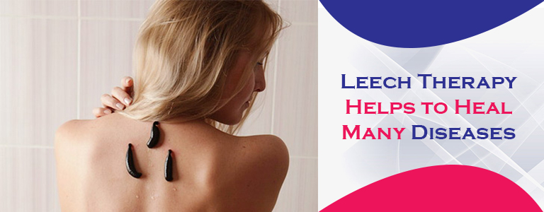 Leech Therapy Helps to Heal Many Diseases