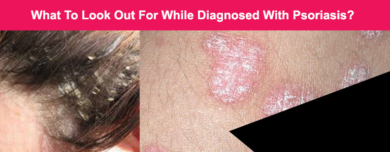 What To Look Out For While Diagnosed With Psoriasis