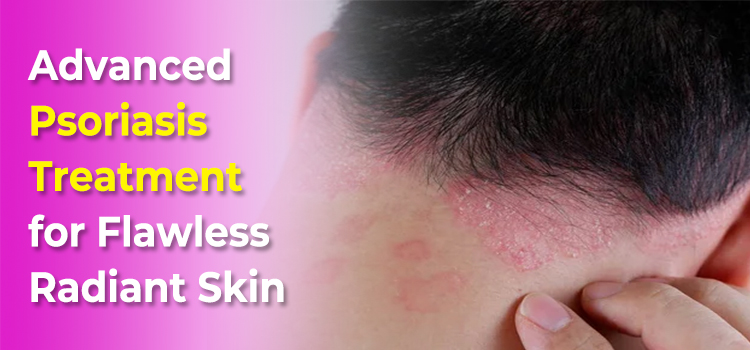Advanced Psoriasis Treatment for Flawless Radiant Skin